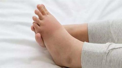 علامة تظهر على قدميك تكشف الإصابة بأمراض الكلي